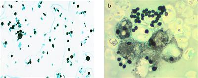 Cytological and Histopathological Spectrum of Histoplasmosis: 15 Years of Experience in French Guiana